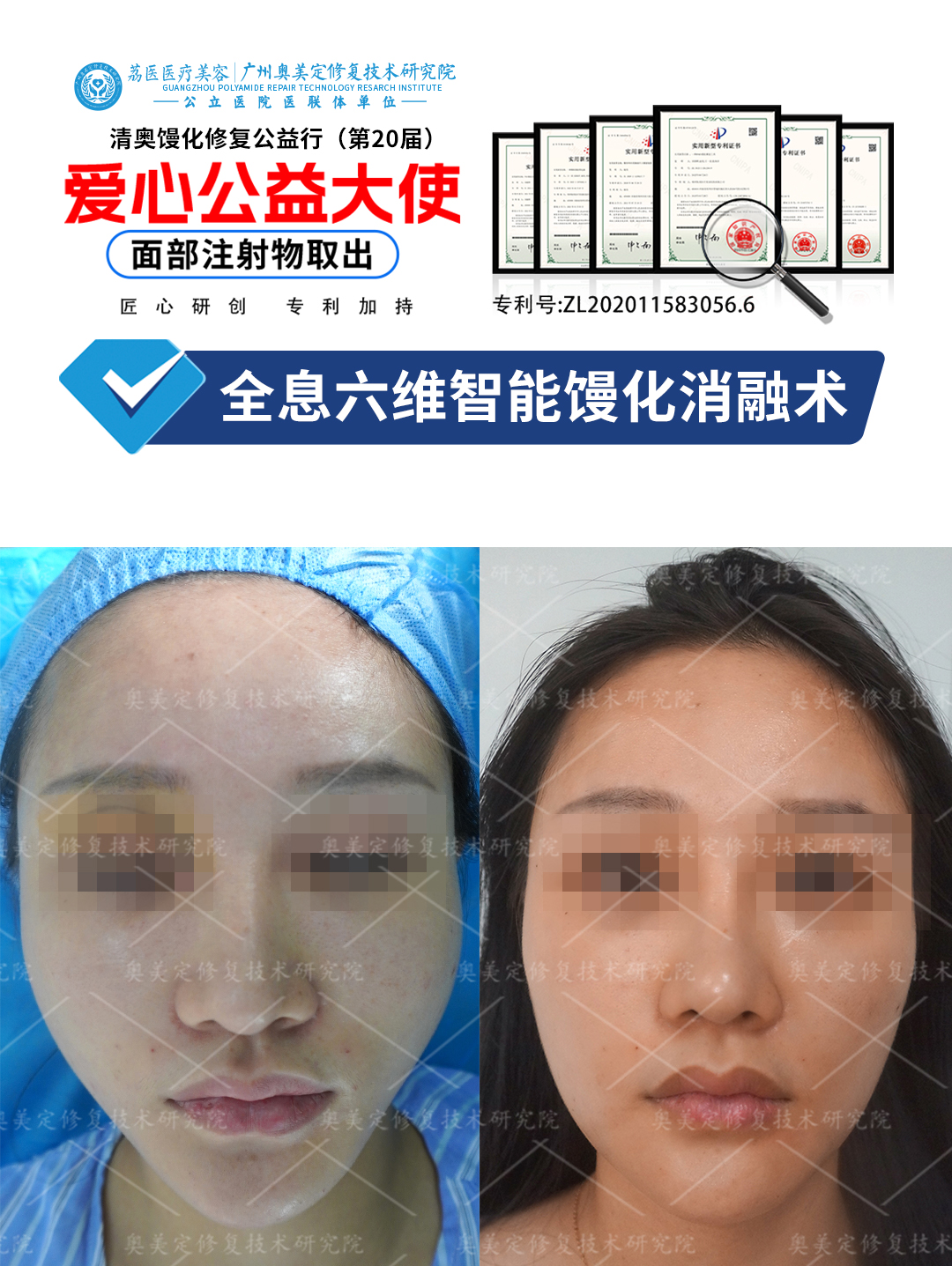 面部馒化后还能修复吗