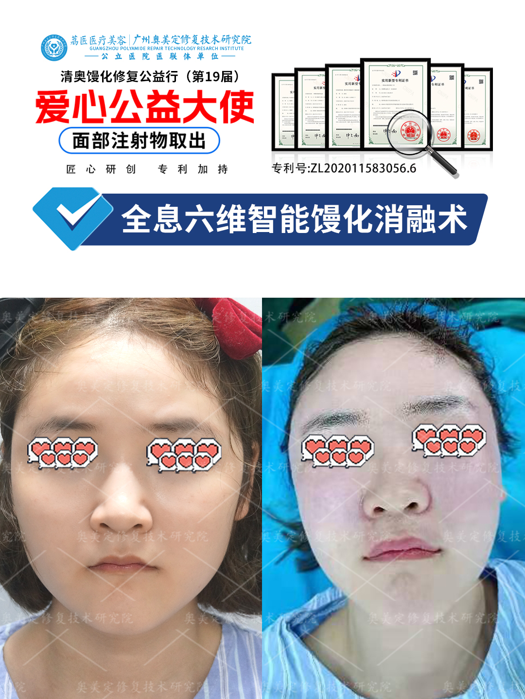 苹果肌打了生长因子怎么取？