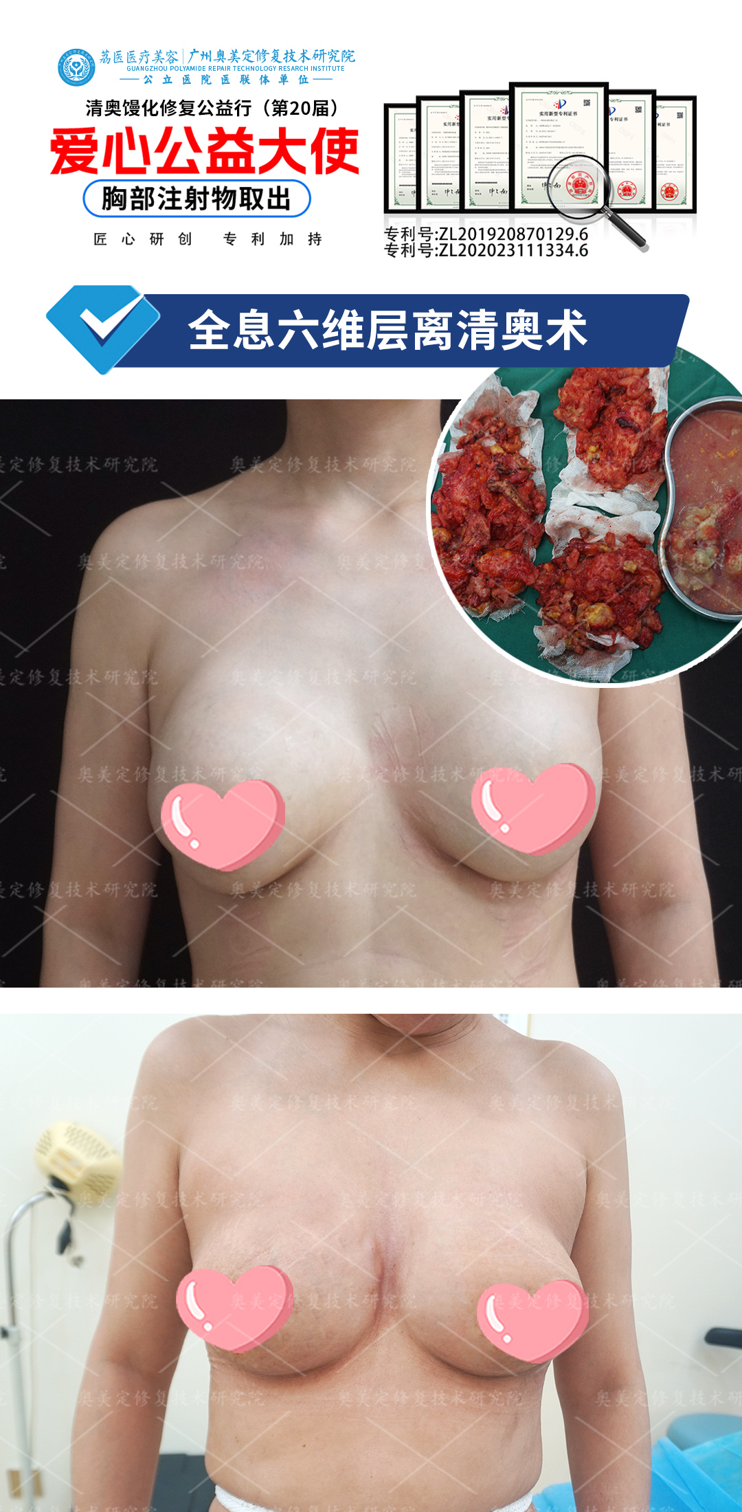 奥美定隆胸18年后还能取出修复吗？