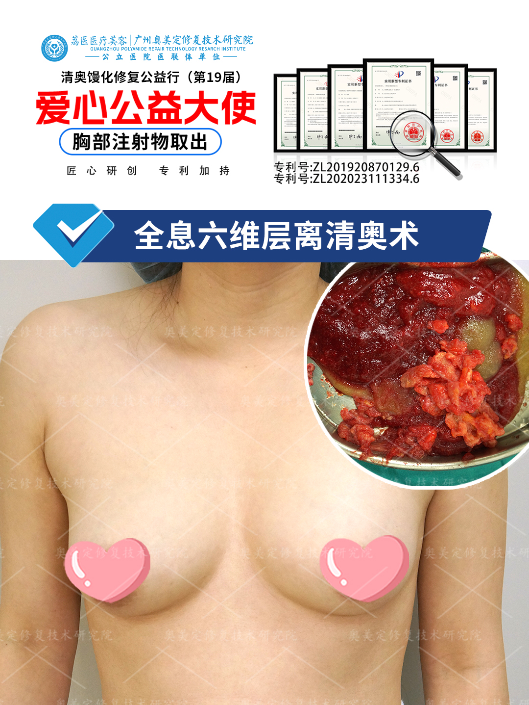 奥美定隆胸12年后有哪些危害？