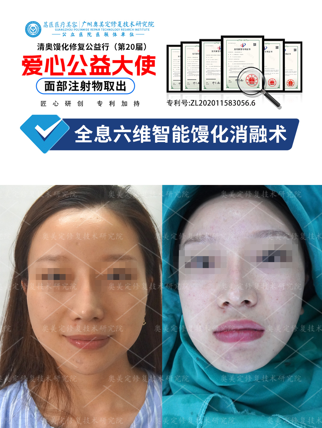 面部打了生长因子怎么取出修复？