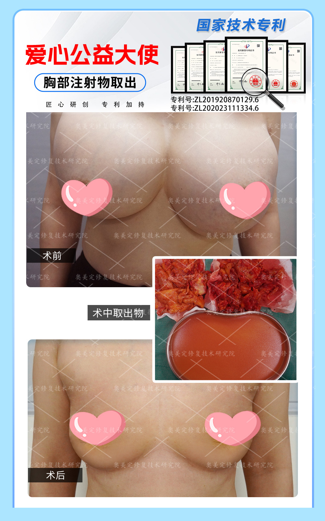 奥美定隆胸10余年后，来院成功取出修复