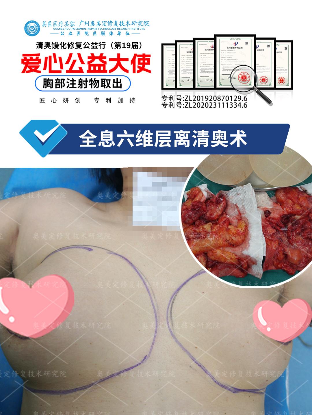 女士胸部注射奥美定，肿胀变形、假感突出，紧急来院取出修复