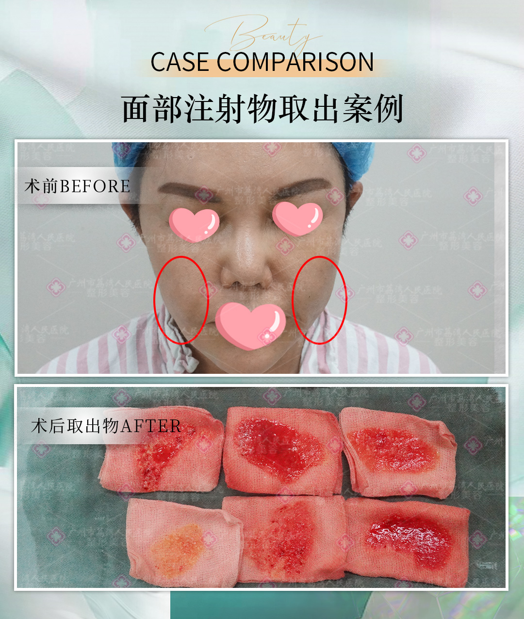 假玻尿酸要取出吗