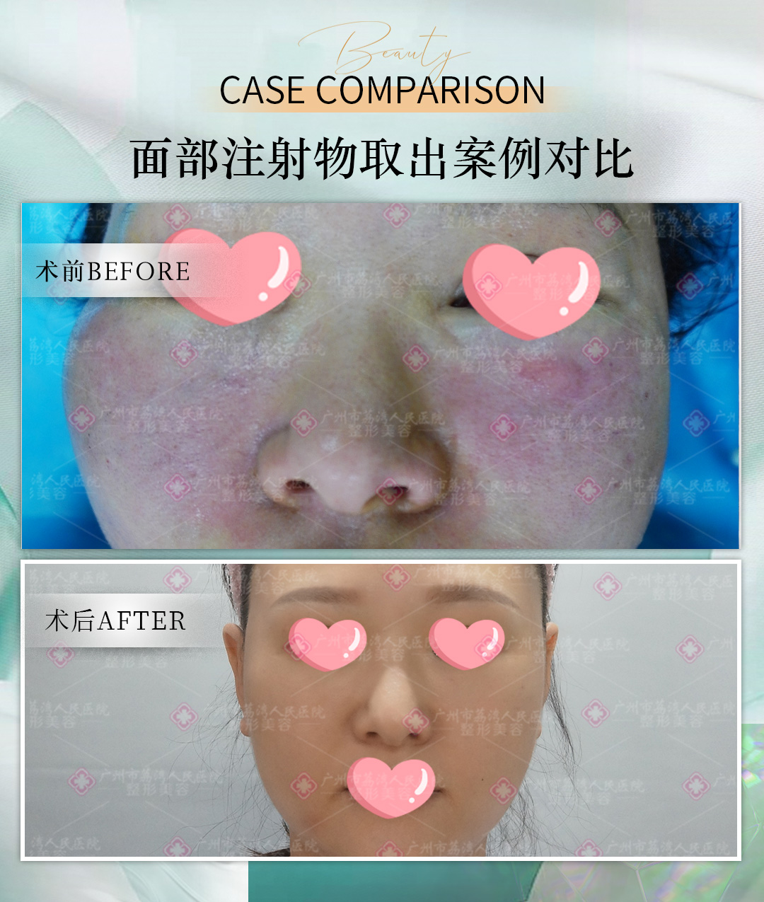 奥美定怎样取出