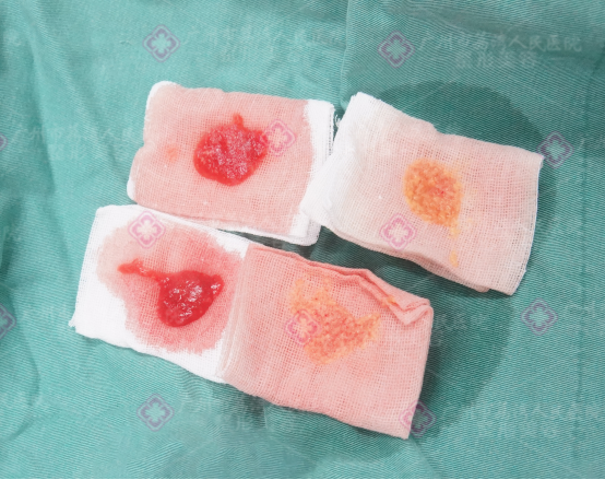 奥美定可以取出干净吗