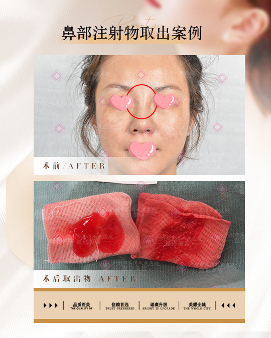 如何取出鼻部奥美定