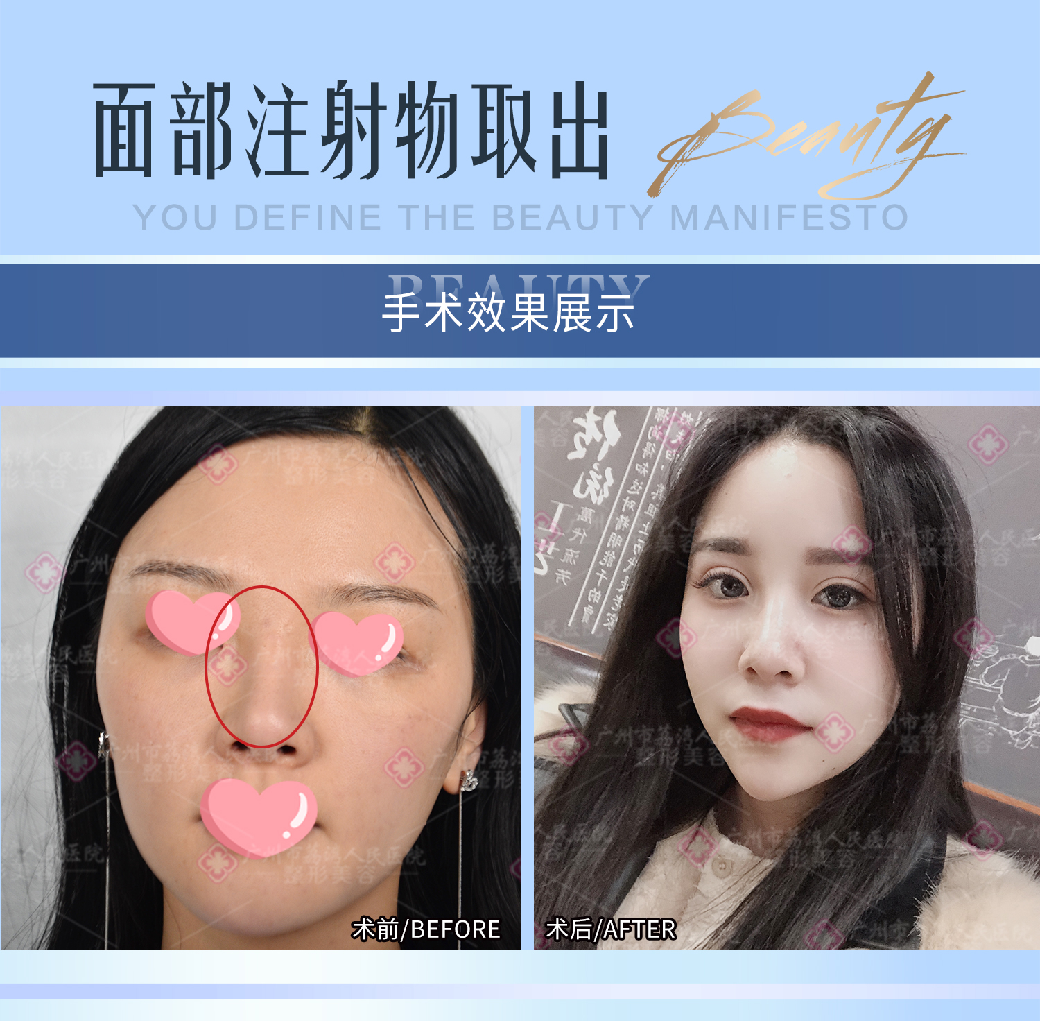 玻尿酸注射填充后一直有硬块要取出吗