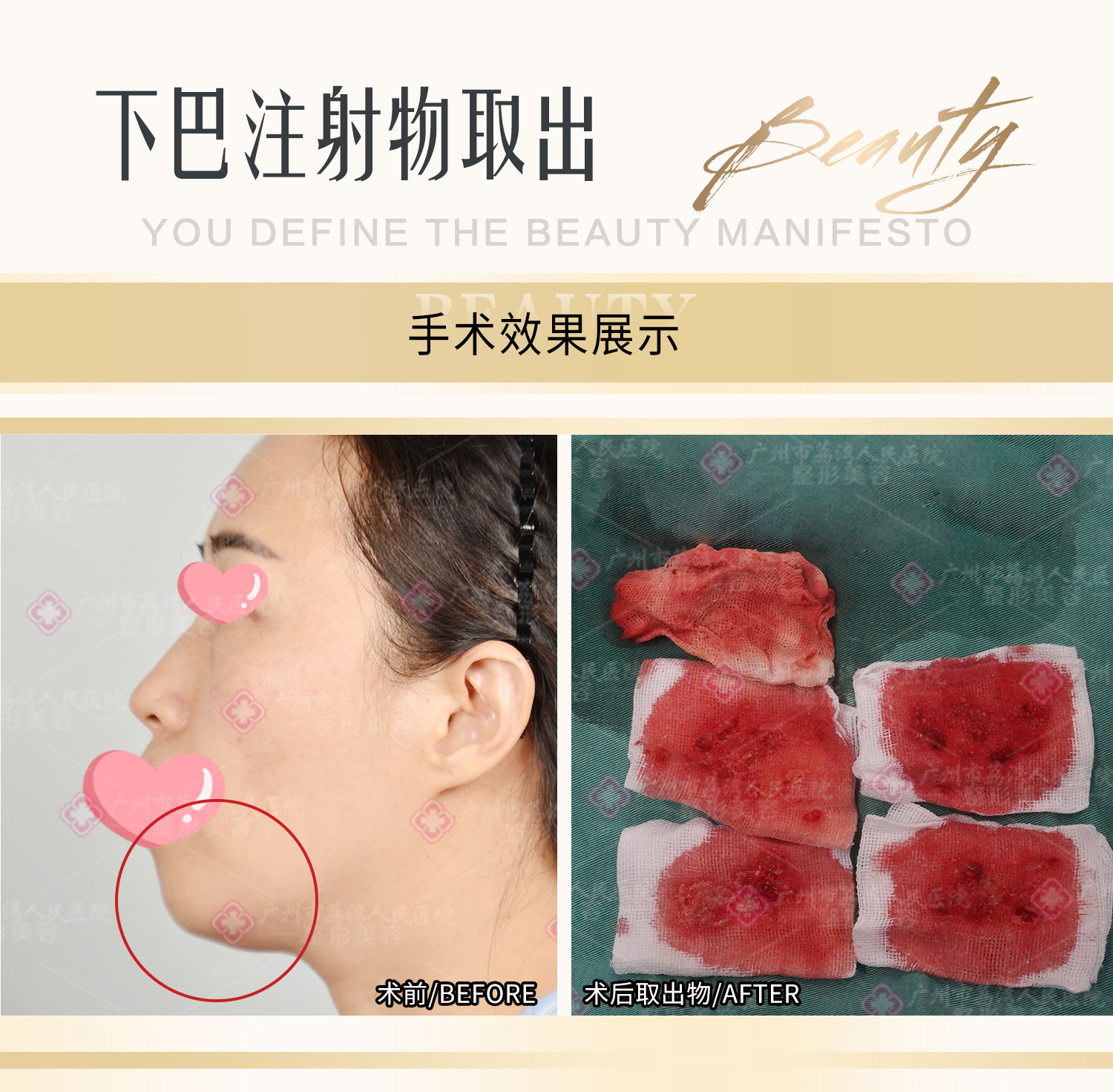 下巴奥美定如何取出