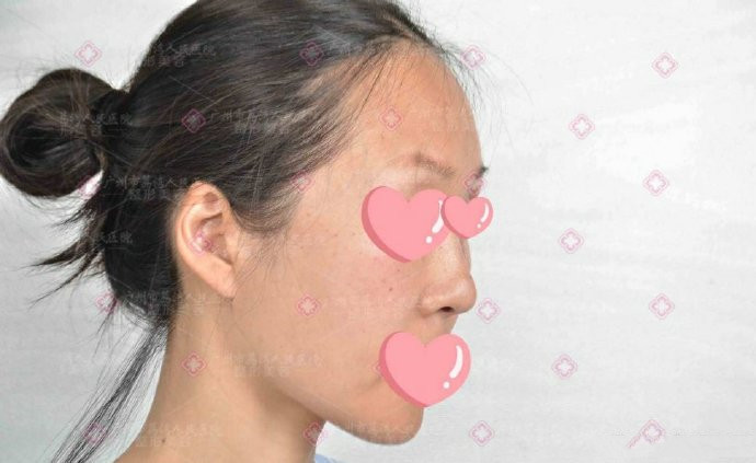 生长因子注射后为什么会不断增生