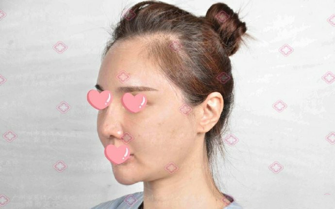 注射假玻尿酸怎么取出修复