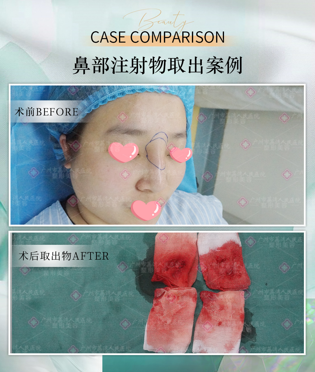 奥美定隆鼻后如何取出