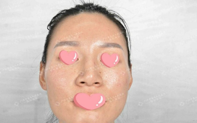 怎么取出面部注射物