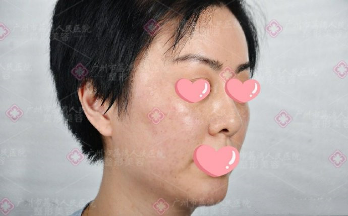 玻尿酸打面部不吸收不溶解怎么回事