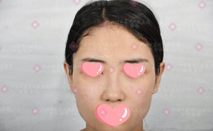 面部打的好像假玻尿酸应该怎么解决呢