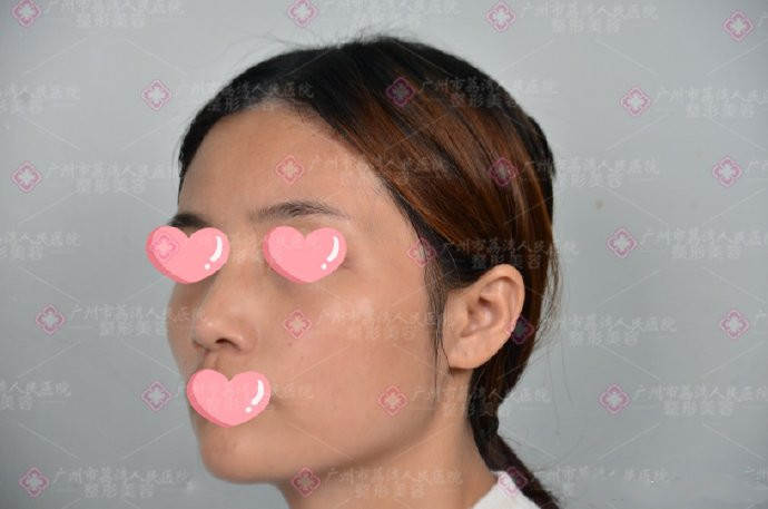 面部填充奥美定如何取出呢