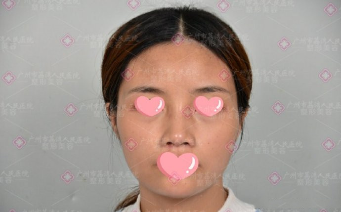 生长因子注射后为什么会毁容呢