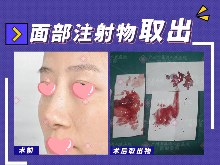 奥美定怎么取出比较好呢？