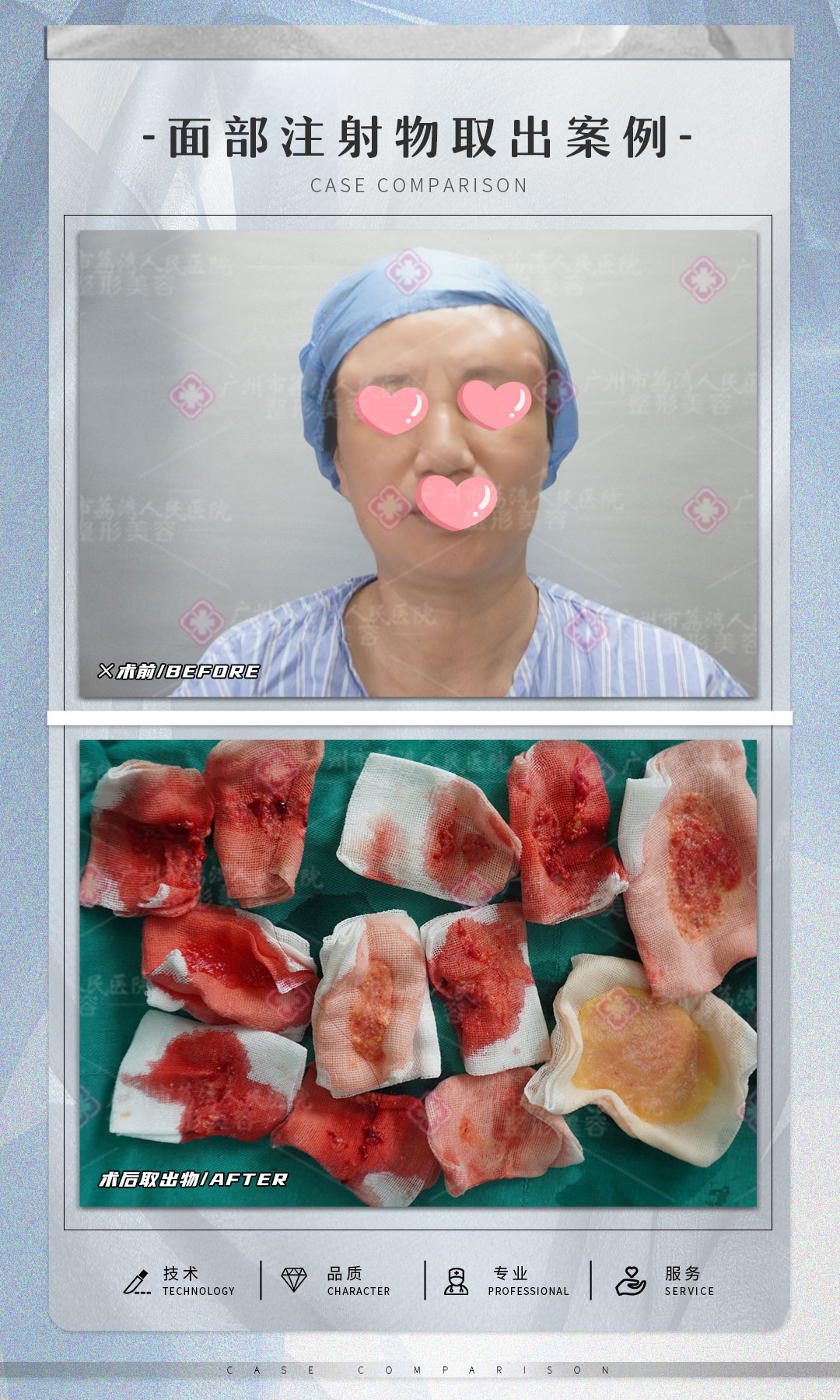 奥美定注射后还能取干净吗？