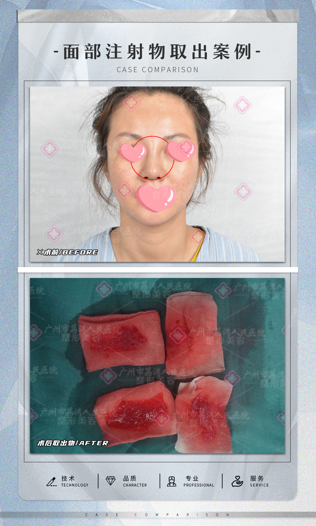 打了玻尿酸不吸收是怎么回事？