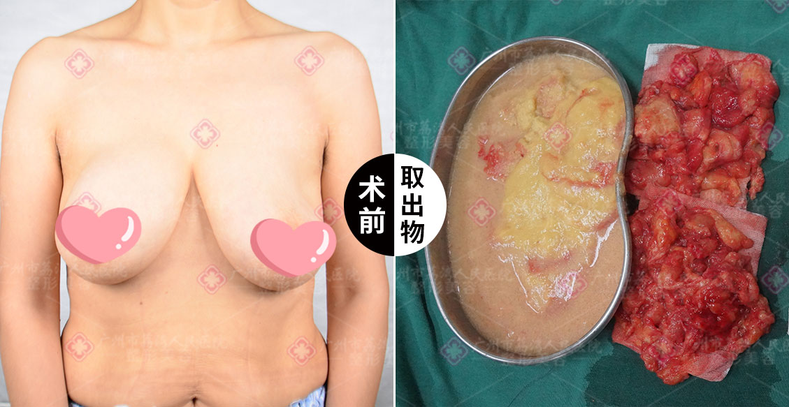 奥美定不取出会怎么样