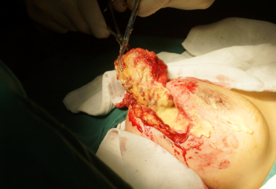 变异鱼籽状型的非法注射物危害大吗