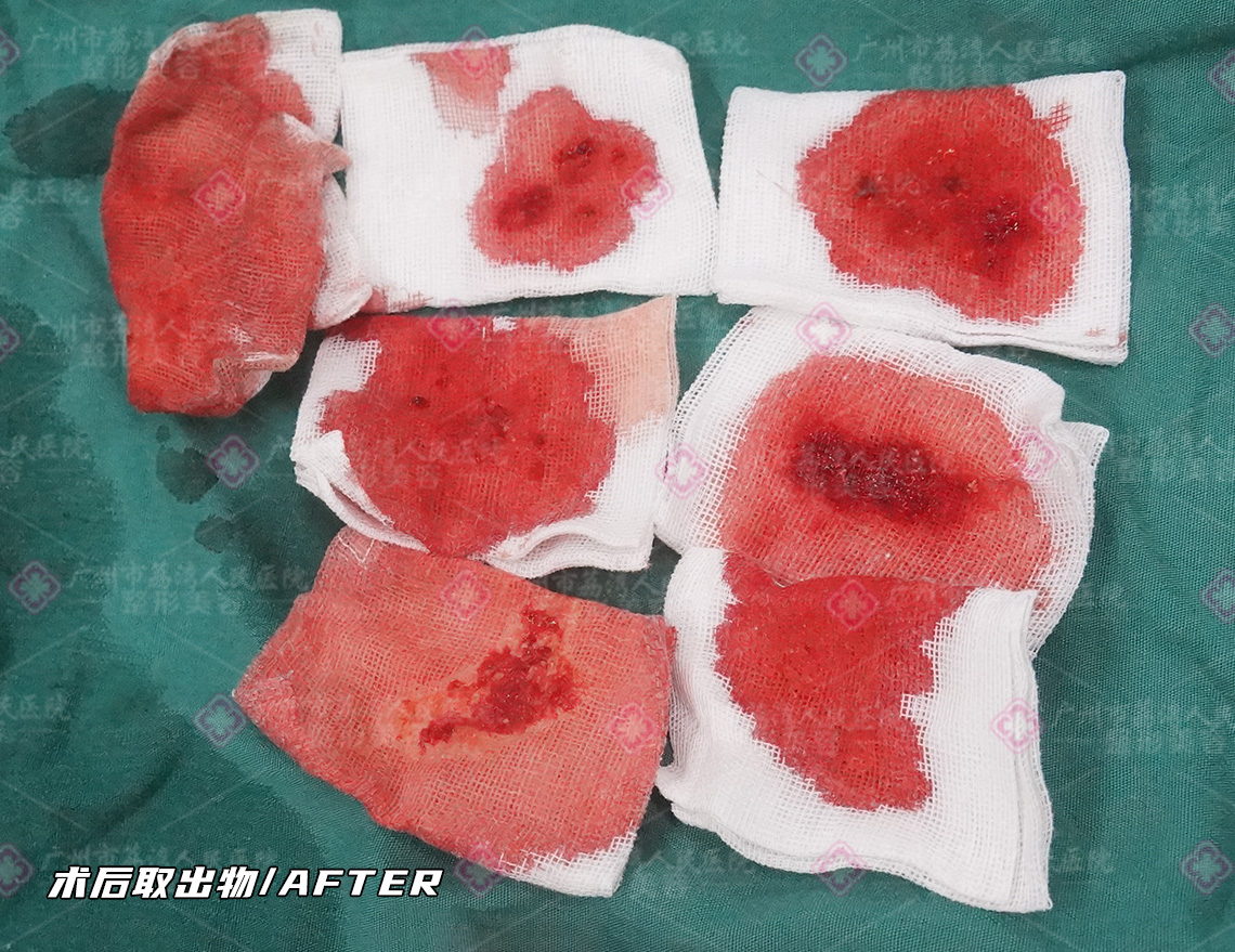 捷克水分子丰体针注射物形成硬块怎么办