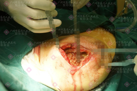 变异鱼籽状型的注射物危害有多大呢