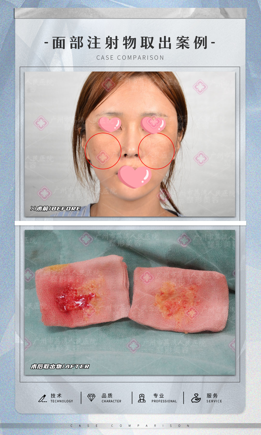 奥美定取出是否会留疤？