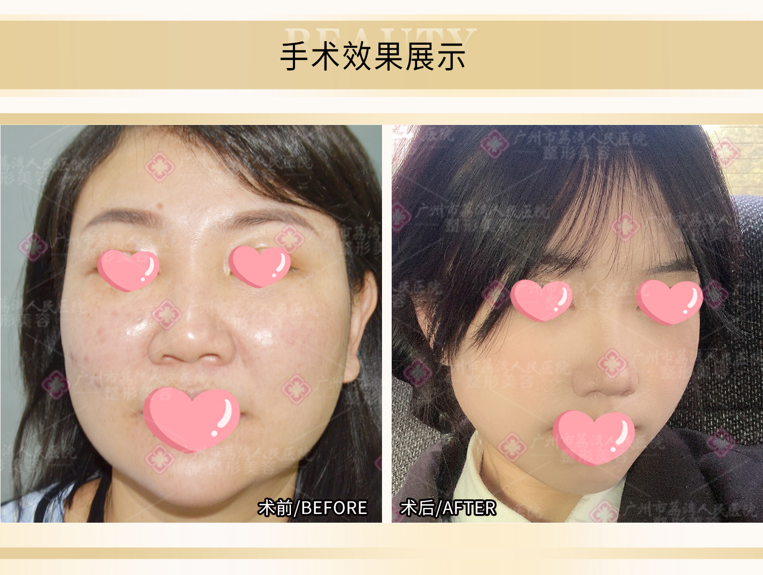 怎么取出面部的奥美定•第十五届关爱女性•清奥公益行