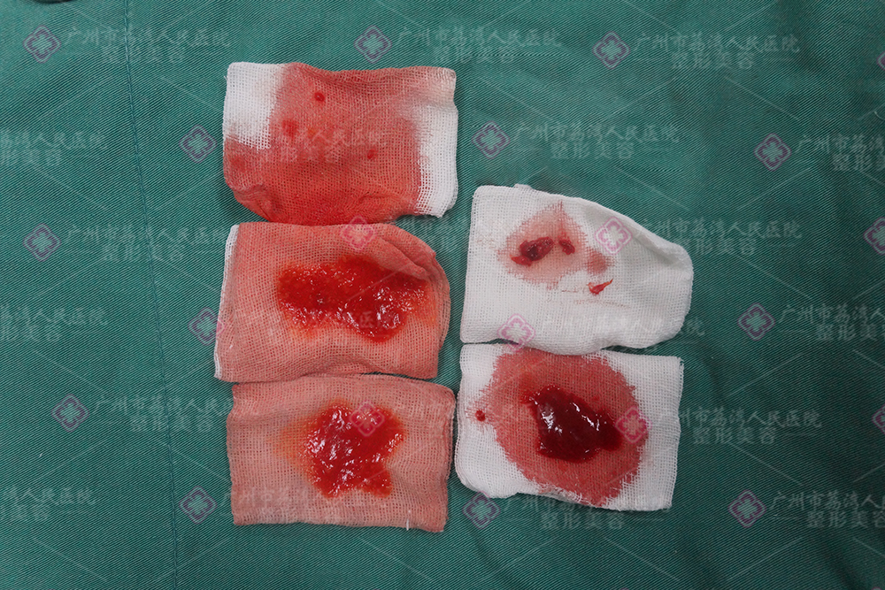 胸部捷克水分子丰体针注射后要取出吗