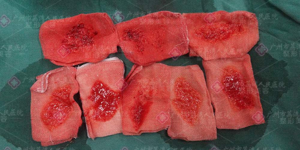 水分子丰体针的成分是奥美定吗