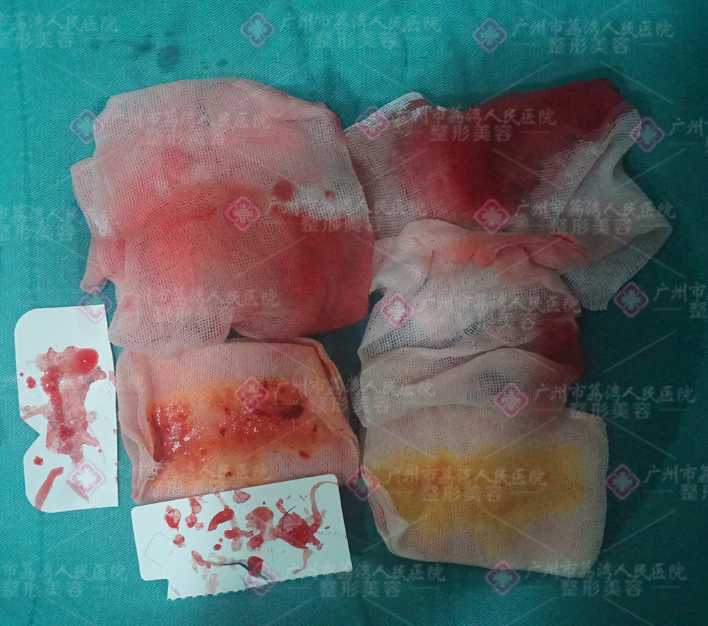 水分子丰体针能百分百取出吗