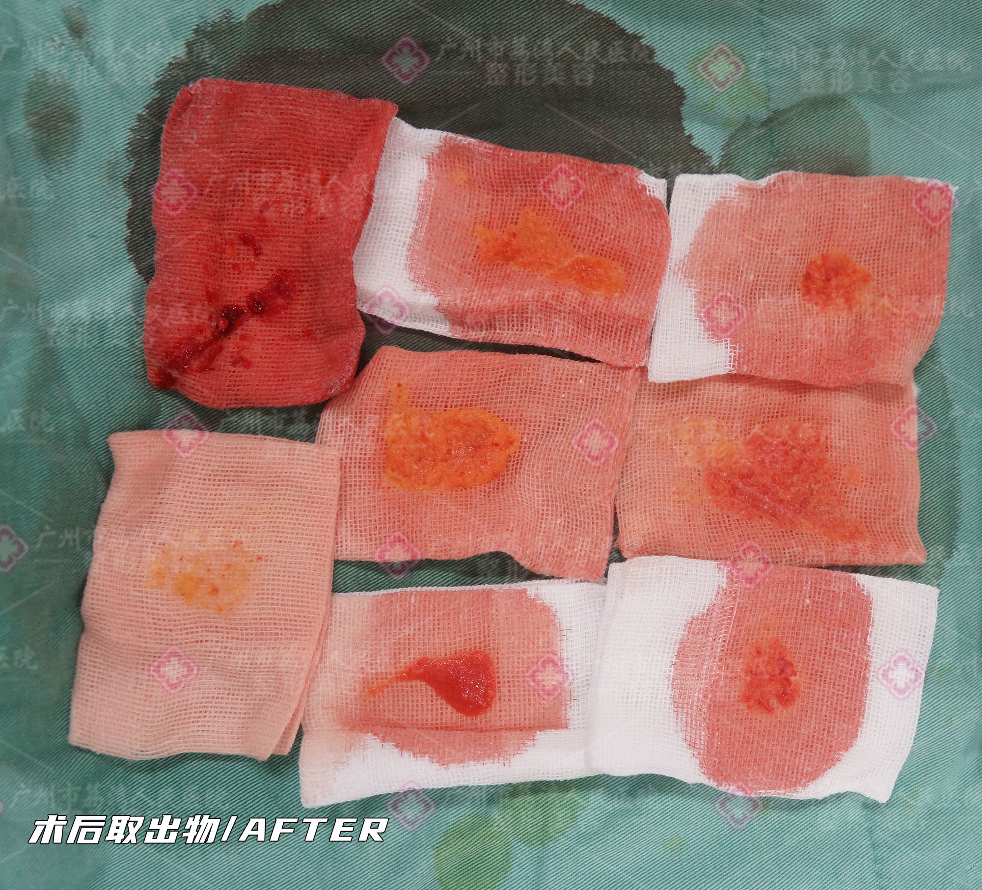 捷克水分子丰体针注射丰胸后怎么取出来