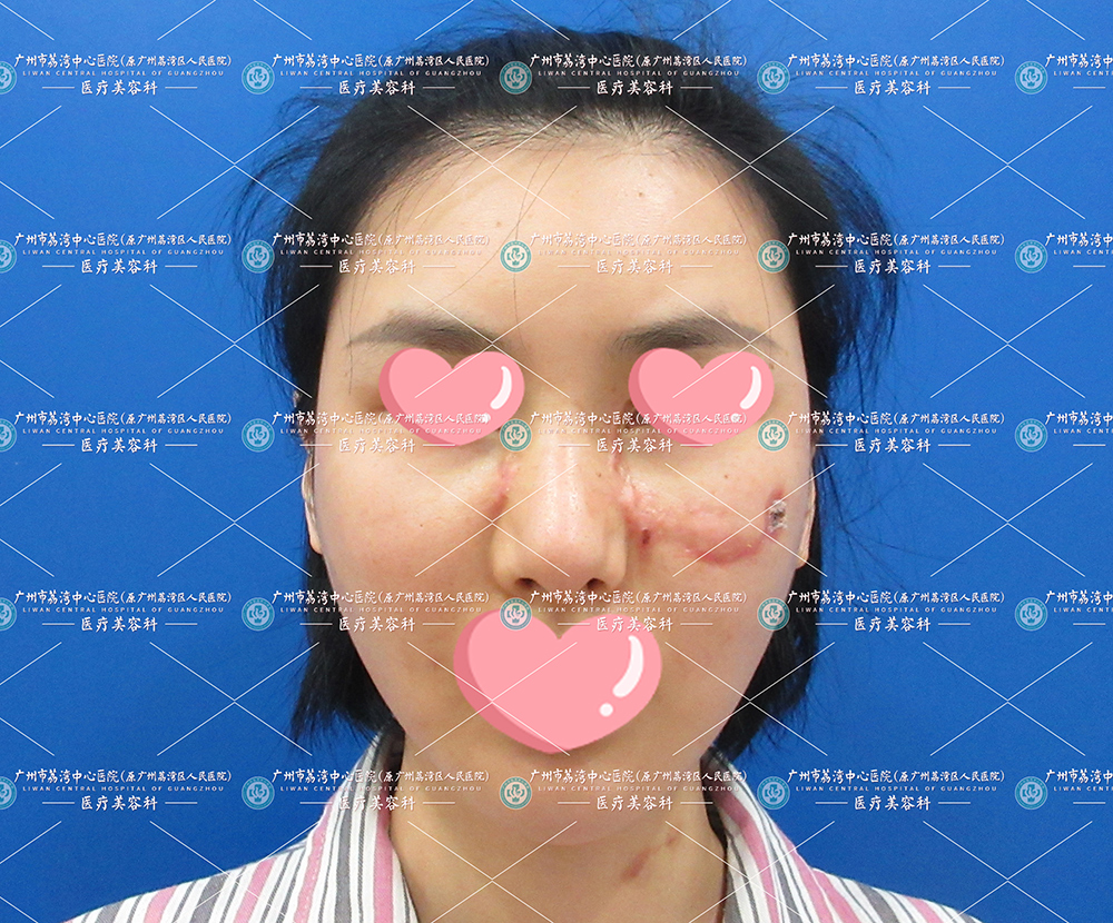 从整容到毁容，小姐姐打了生长因子烂脸破溃，每天睡醒枕头都是脓液