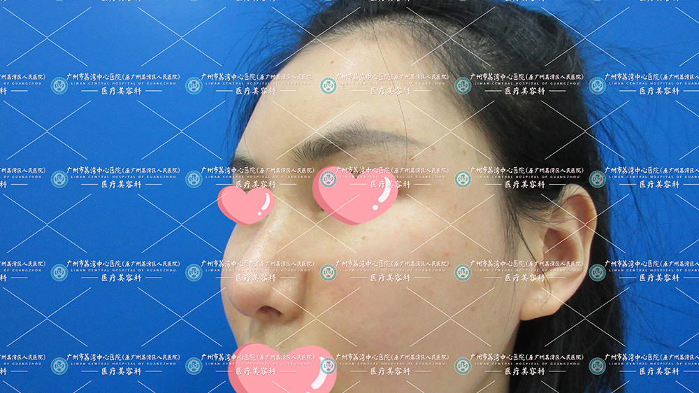 这是小姐姐取出修复2年后的样子，根本看不出现之前烂脸的样子。