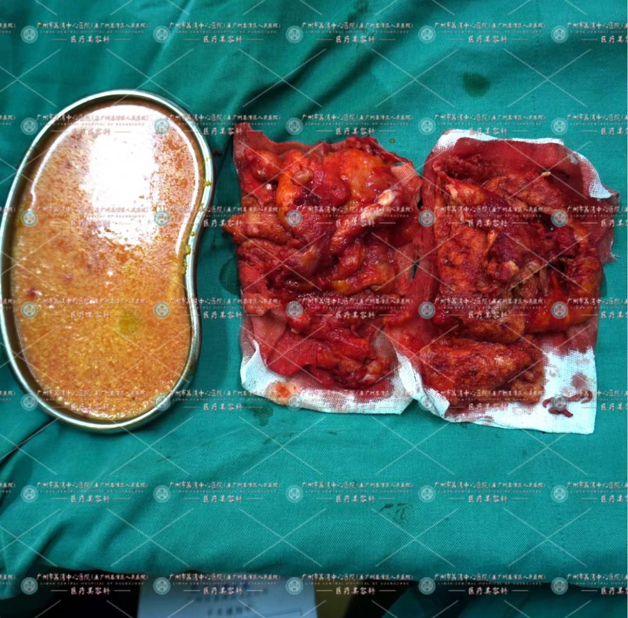 捷克水分子隆胸后，取出如鸡油般的包膜组织