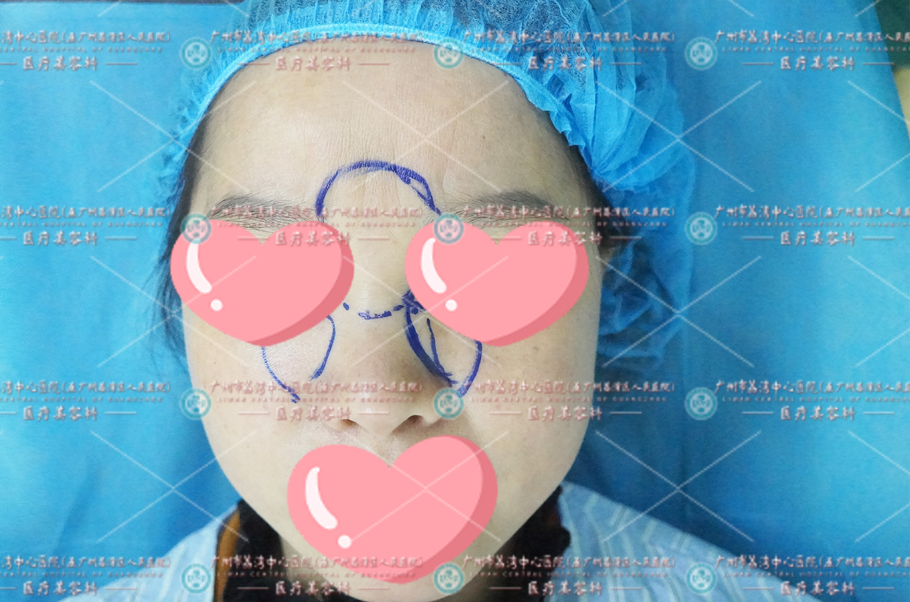 可怕！女子注射变美却在面部埋下一颗“定时炸弹”