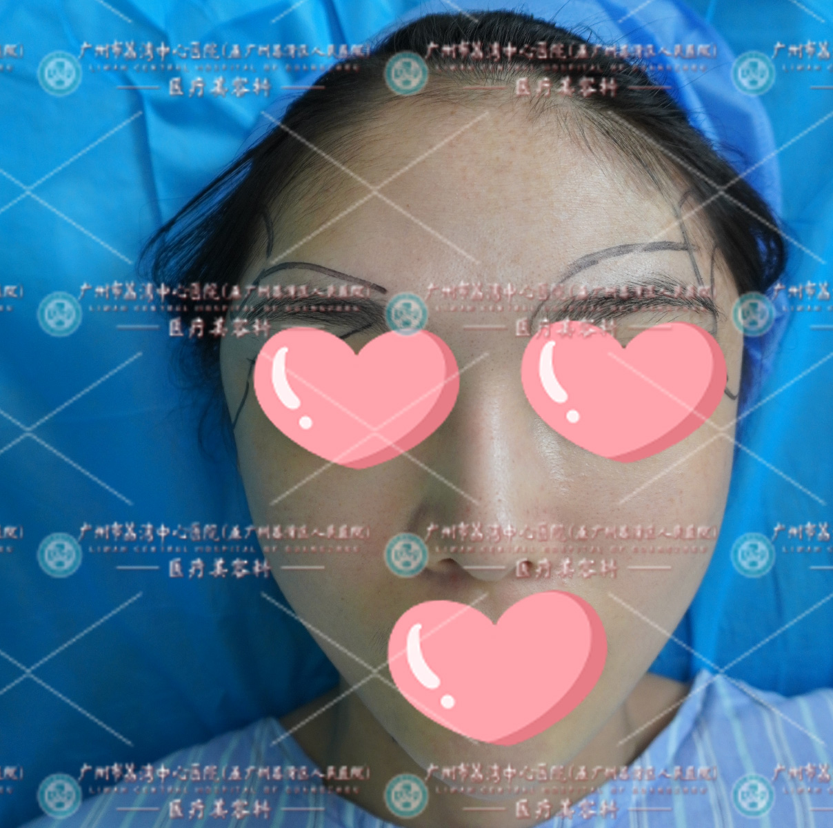 22岁年轻女性打奥美定肿胀隆起，神似“外星人”，简直可怕！