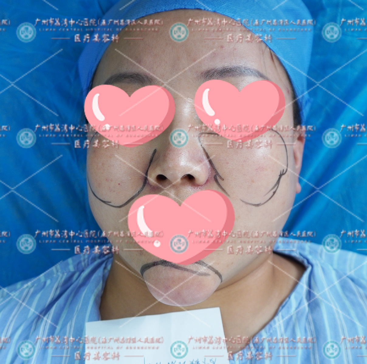 苹果肌、下巴打美容针出现严重变形，无法辨认模样，取出成“奥美定”