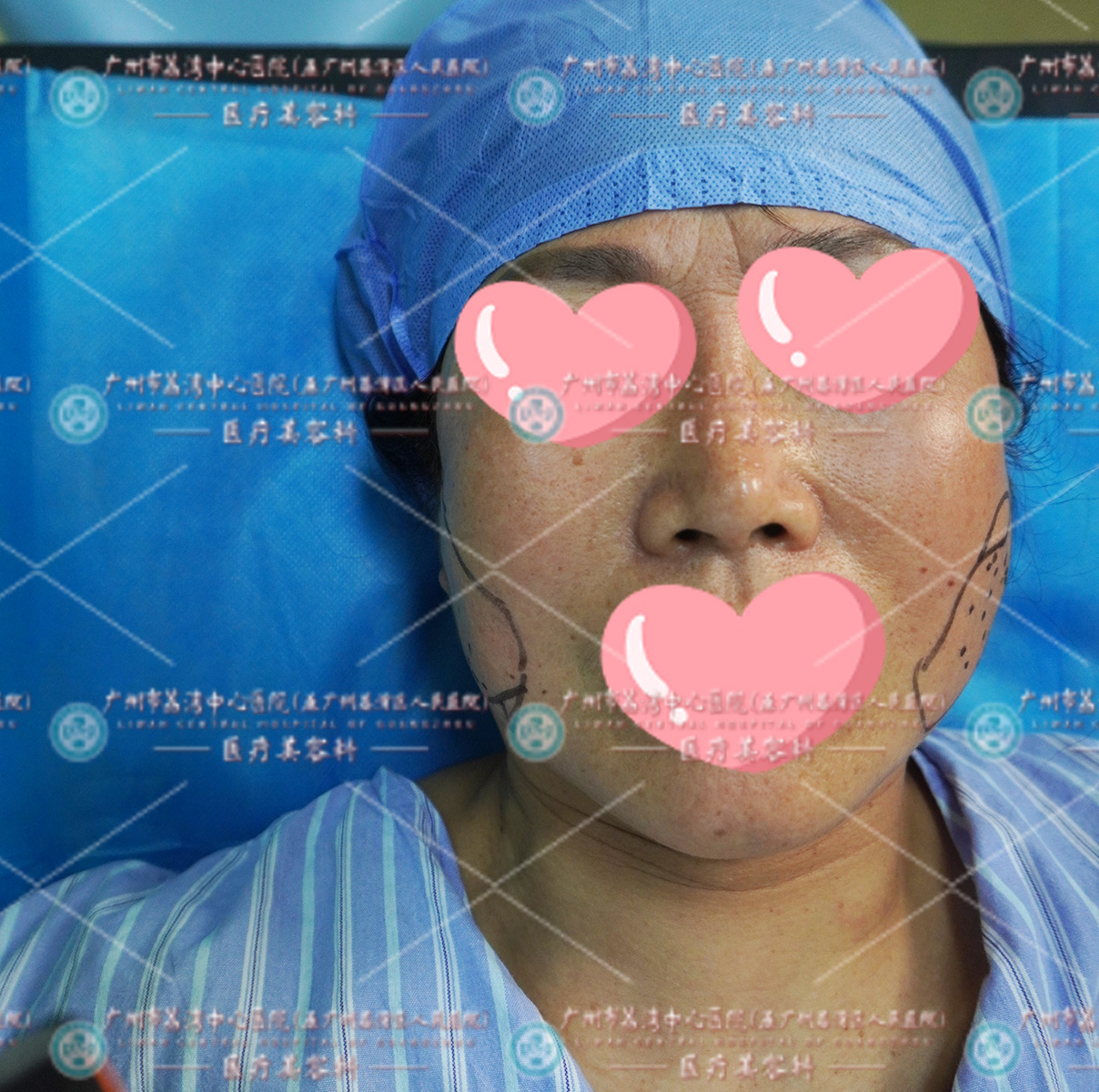 43岁女士打奥美定脸颊肿胀突起，来做取出修复