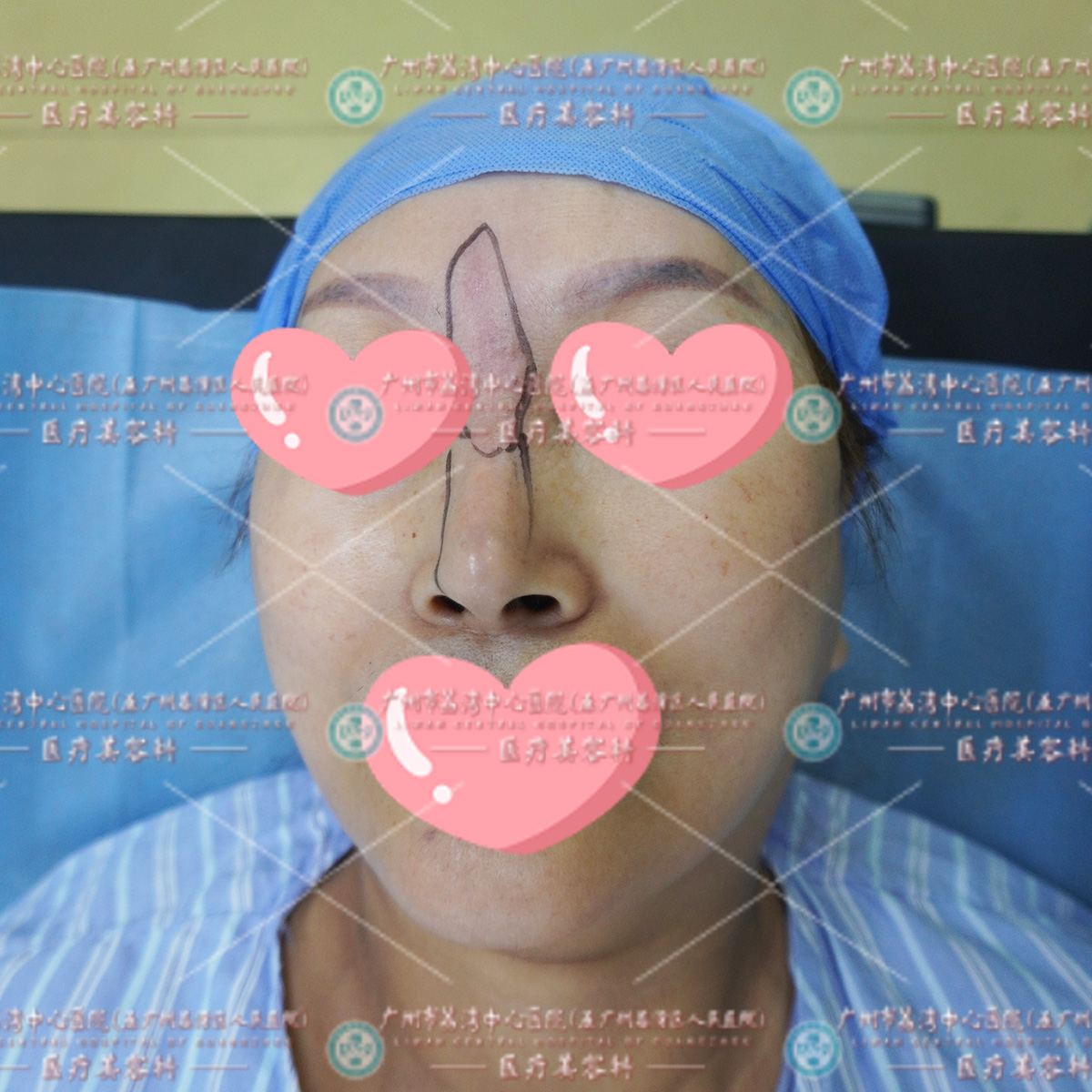 这位患者为了改善自己的鼻型，她选择了注射奥美定进行隆鼻，但是这次手术的结果却远非她所期待。  注射奥美定后的一段时间内，她发现自己的鼻子开始出现了异常。原本应该固定在鼻子部位的奥美定，竟然游离到了眉间，原本挺拔的鼻梁变得歪曲，鼻孔也变得不对称，这不仅严重影响了鼻子的美观，还带来了心理上的不适。  面对这种情况，她开始积极寻找能够取出奥美定的医院，经过仔细比较和考虑，最终选择我院进行手术。  我们根据这位患者的具体情况制定了详细的手术方案，通过精细的操作，成功地将游离的奥美定取出，并对鼻子进行了修复，整个手术过程耗时较长，但患者在医护人员的精心照料下，顺利度过了手术期，经过一段时间的术后恢复，她的鼻子逐渐恢复了正常。  像黑医美机构这类机构，如今在整形市场上层出不穷，他们往往利用奥美定冒充正规的玻尿酸，不顾爱美者的健康，售卖给需要注射玻尿酸的求美者，导致不少爱美者深陷其害。  因此，选择一个正规、专业、公立的机构显得尤为重要。爱美者在选择整形美容机构时，首先要查看其是否具备相应的资质和证书，也要关注医生的资质和经验，可以查看其过往的手术案例、患者评价和学术成果等，以了解其专业水平和口碑。建议大家谨慎选择。