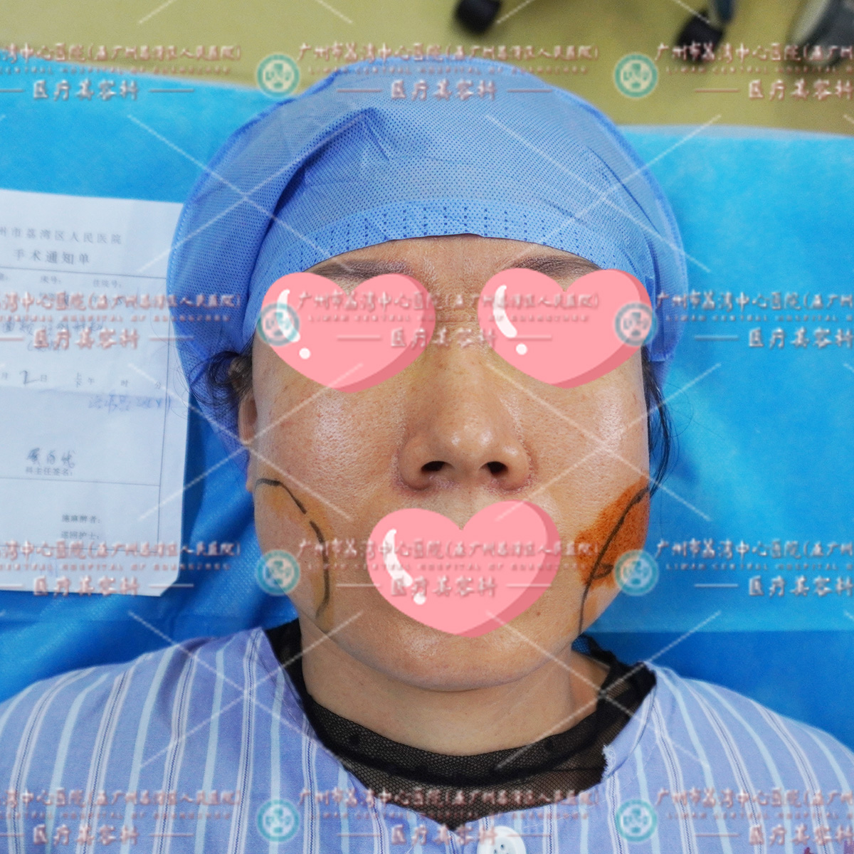 脸上打生长因子出现疯长增生，一场美容变悲剧