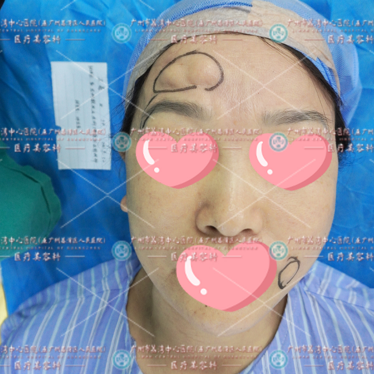 额头填充奥美定18年，肿胀变形很怪异，来院做修复