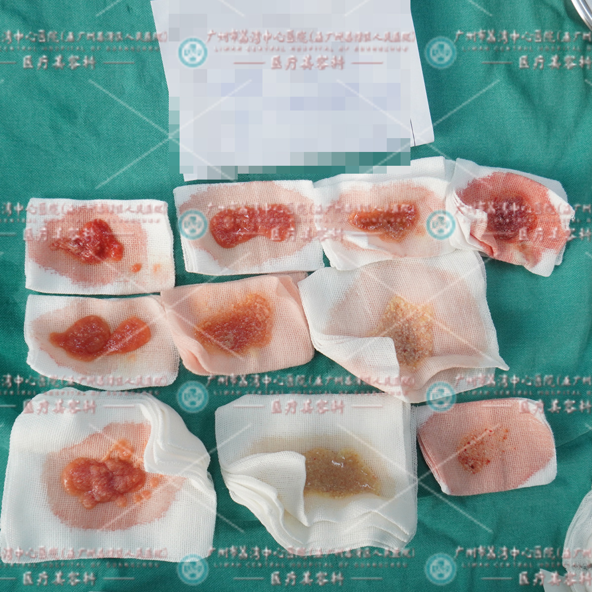 打非法材料15年后想要取出，脸颊两侧发红肿胀，术中渗出如"米粥"状般材料