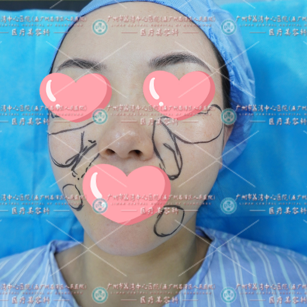 全面部填充“玻尿酸”严重变形，取出后重返美丽人生