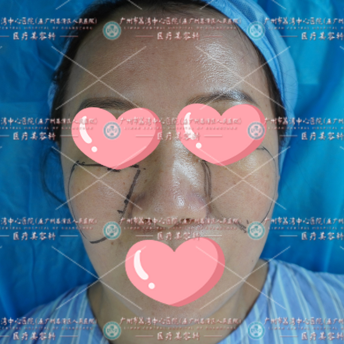 面部打了奥美定如何取出呢？