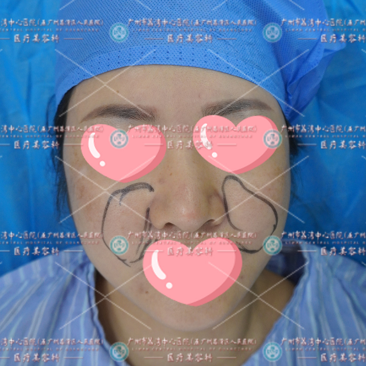 女士脸部填充除皱后，竟差点成了“面瘫”？来我院取出后恢复了笑容