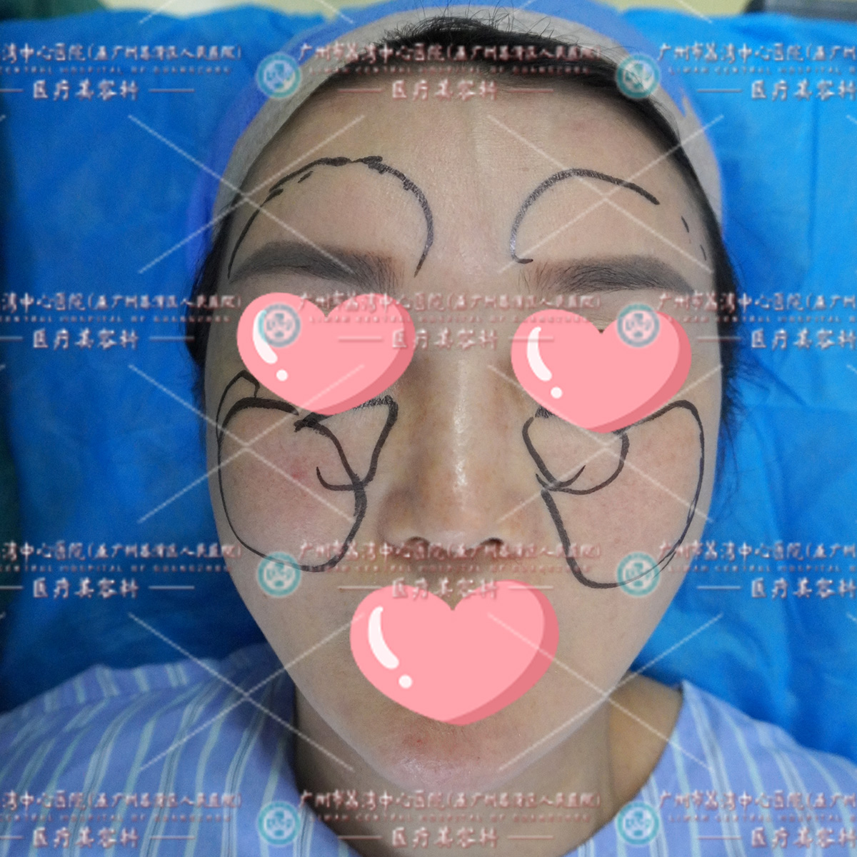 轻信街头小广告往脸上打“玻尿酸”，结果是奥美定，红肿硬块，甚至游离到额头才来做取出