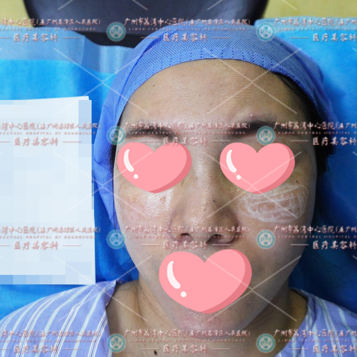 这位美女七八年前打了奥美定隆鼻，半年后开始感觉到鼻子发红肿胀，症状逐渐加重，还出现了变形，总感觉里面装了个定时炸弹，一直想要做取出修复，所以来到我院。  我们经过检查后，确定她鼻部组织还算是完好，给出的方案是在做奥美定取出手术后，恢复一段时间可以再做个鼻综合进行修复。  术后，这位美女恢复的速度还是比较快的，取出的很干净，没有后遗症。  奥美定是什么？它到底能不能用来隆鼻？  奥美定即聚丙烯酰胺水凝胶，俗称人造脂肪，是一种无色透明类似果冻状的液态物质。曾广泛用于隆胸、隆鼻、丰臀等整形项目。聚丙烯酰胺水凝胶本身是无毒的，但注入人体后会分解成有毒的单体丙烯酰胺。  奥美定注射人体之后并不会马上出现并发症，潜伏期通常2-10年，很多非正规机构用奥美定冒充玻尿酸，甚至她们自己都不知道给顾客注射的是什么。因此，建议爱美者一定要选择正规公立机构进行注射整形。  奥美定隆鼻后遗症小课堂：  1、鼻子变形：由于奥美定具有游走性，而鼻部组织不平整，且为表情丰富部位，一旦受到外力、重力的影响，奥美定就会发生渗漏扩散，导致鼻子变形。  2、皮肤溃烂：由于鼻子部位的皮肤较薄，奥美定注射在皮肤下，局部张力过大，严重的会引起皮肤缺血坏死，出现破损溃烂。  3、疼痛：奥美定注射进入人体内后，会产生有毒的单体，会侵蚀生理组织，腐蚀血管、肌肉，导致组织病变，并伴随疼痛。  4、引发其他病症：奥美定游走，分解成有的毒单体。